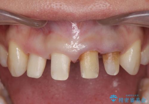 変色した歯を改善、セラミック治療の治療中