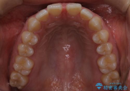インビザライン矯正 前歯のすきっ歯を治したいの治療前