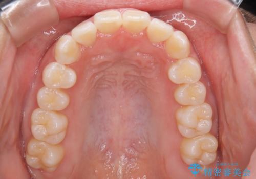 インビザライン矯正 短期間でがたつきのない歯並びに!の治療後