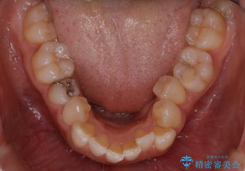 ワイヤー矯正　抜歯本数を最小限にし、八重歯のない歯並びに　の治療前