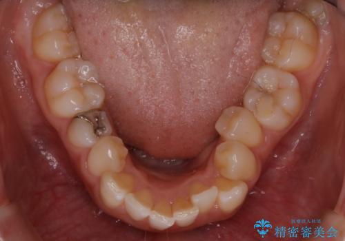 ワイヤー矯正 抜歯本数を最小限にし、八重歯のない歯並びに の治療前