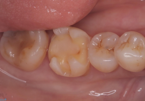 歯と歯の間に物がよく詰まるの治療中