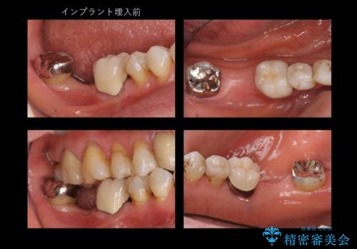 60代女性 奥歯のインプラント の治療前