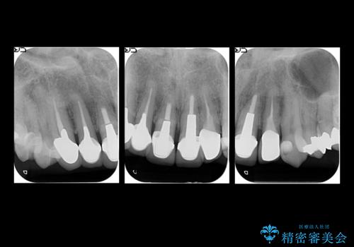 前歯のセラミック 神経の再治療からの治療前
