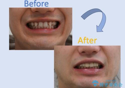 前歯のすきま　生まれつき歯が少ないのを治療