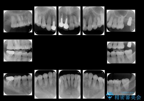 全体的な虫歯治療 他院で入れたインプラントの続きもの治療前