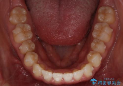 インビザライン矯正 前歯のすきっ歯を治したいの治療中