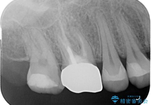歯の間に食べ物がよく挟まるのを治したいの治療後