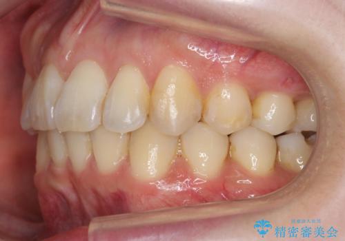 やや難ケース 上の歯を抜かずに歯列を後ろに下げて治療 4本ではなく下1本のみの抜歯できれいにの治療後