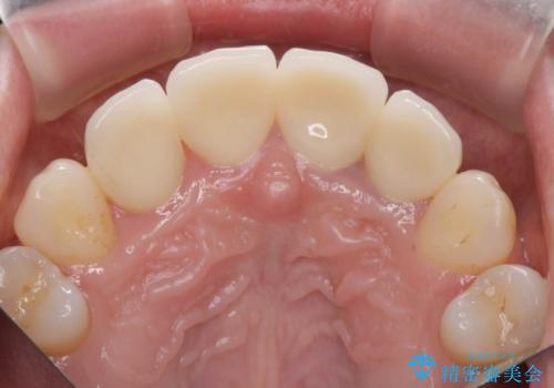 変色した歯を改善、セラミック治療の治療後