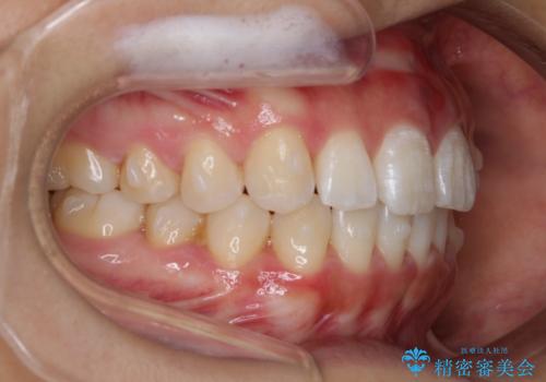 インビザライン矯正 前歯のすきっ歯を治したいの治療中