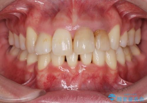変色した歯を改善、セラミック治療の治療前