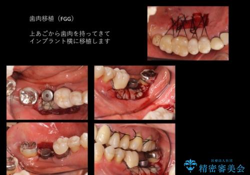 60代女性 奥歯のインプラント の治療中
