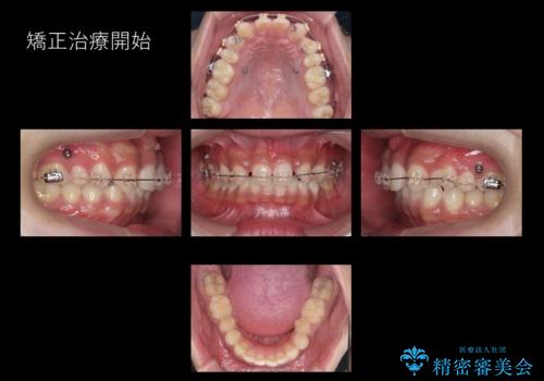 前歯のすきま 生まれつき歯が少ないのを治療の治療中