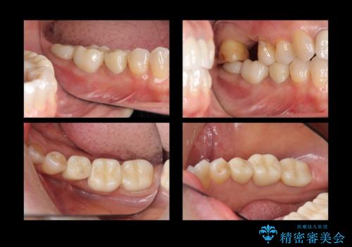 奥歯の高さがない 歯周外科で解決の治療中