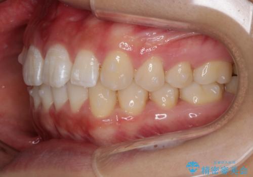インビザライン矯正　前歯のすきっ歯を治したいの治療中