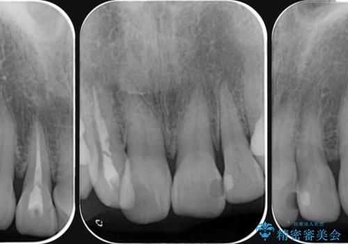 [ テトラサイクリン歯 ] 長年気になっていた変色歯を改善の治療前