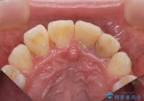 変色した歯を改善、セラミック治療の治療前