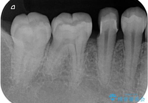 歯と歯の間の虫歯 セラミックインレーでの修復処置の治療中