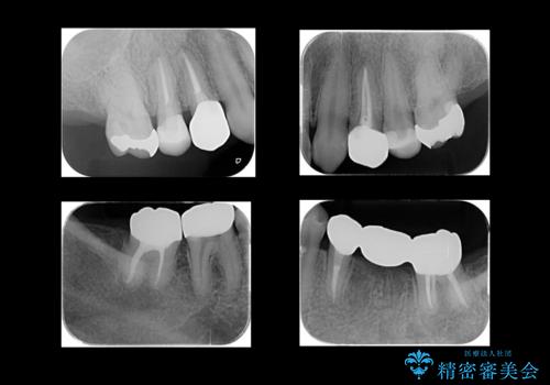 全体的な虫歯治療の治療後