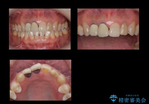 前歯のかぶせもののやり直し、根の治療もの治療前