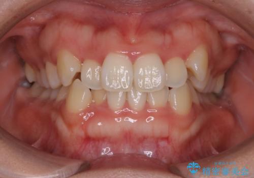 インビザライン矯正　短期間でがたつきのない歯並びに!の症例 治療前
