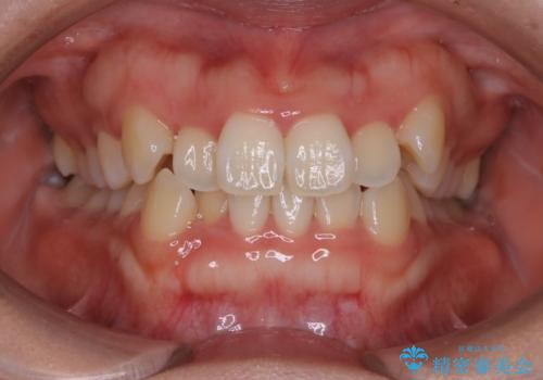インビザライン矯正　短期間でがたつきのない歯並びに!の治療前