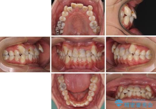 デコボコと変色した前歯　抜歯矯正と審美歯科治療の治療前