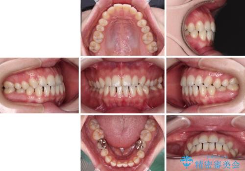 すきっ歯をインビザラインできれいな歯並びに改善の治療前