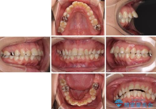 ハーフリンガルで歯列をきれいに セラミック治療で気になる銀歯も自然な色にの治療前