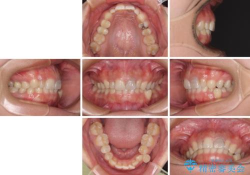 歯列から飛び出た歯 ワイヤー矯正で整った歯列にの治療前