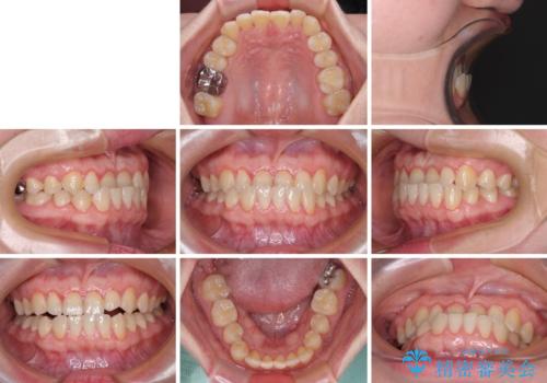 反対咬合を治したい ワイヤー装置で一気に咬み合わせを改善の治療前