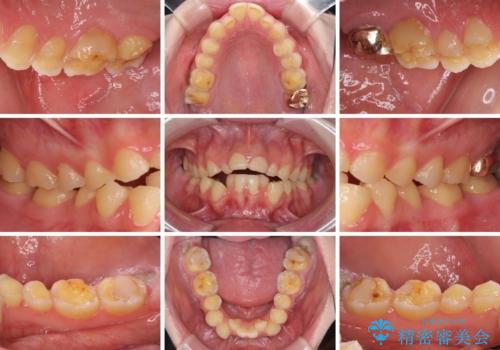 酸蝕歯でボロボロの歯の審美歯科治療　矯正治療も併用して、美しい口元への治療前