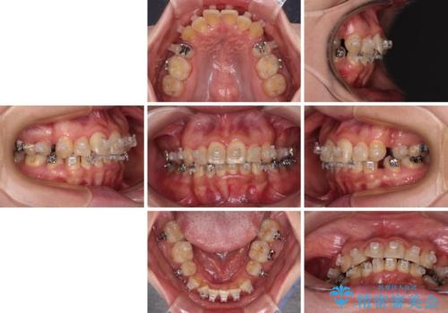 治療途中で帰国 装置をつけた状態を継続して矯正治療の治療前