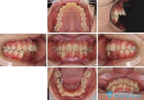 【モニター】出っ歯と八重歯 抜歯矯正でスッキリとした口元にの治療前
