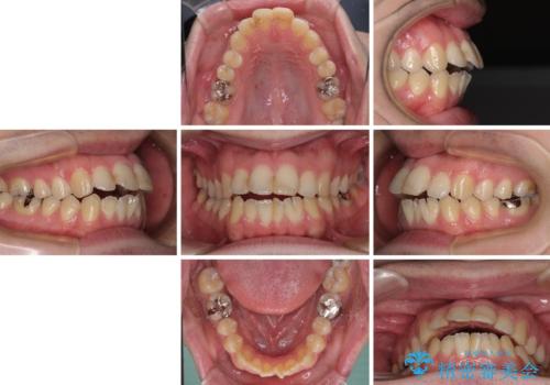 しゃくれて口が閉じられない ワイヤー装置での抜歯矯正の治療前