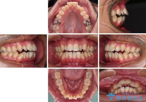 開咬とデコボコを整える　インビザライン矯正治療の治療前