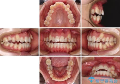 八重歯と開咬の抜歯矯正　ワイヤー装置を併用したインビザライン矯正治療の治療前