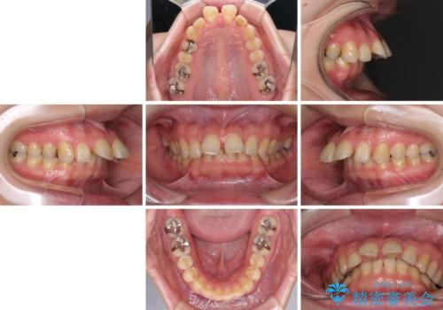 外科手術が必要と言えるほど突出した前歯　長期間をかけた抜歯矯正の治療前