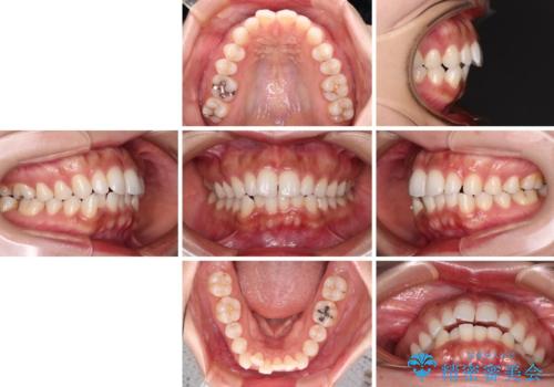 唇が閉じにくい ワイヤー装置での抜歯矯正の治療前