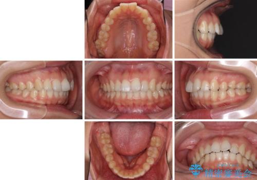 インビザライン矯正で前歯のデコボコを改善の治療前