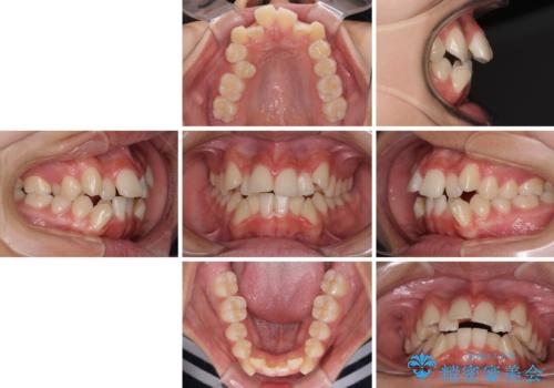 上顎骨幅が狭い 急速拡大装置を併用した抜歯矯正の治療前