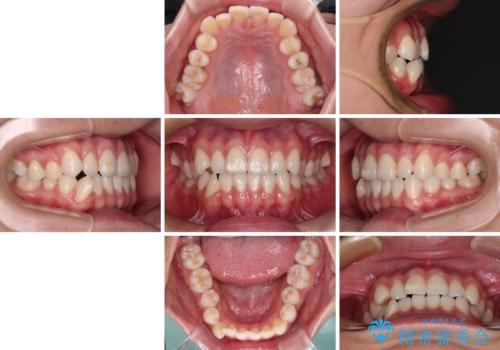 咬み合わせの乱れを改善 ワイヤー装置で楽々矯正治療の治療前
