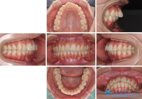 飛び出した前歯を引っ込めたい ワイヤー装置での抜歯矯正の治療前