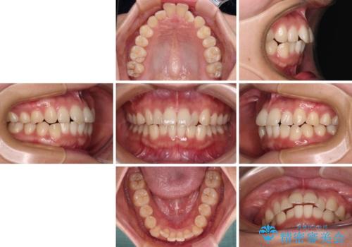 上下前歯のデコボコ ワイヤー装置で楽して改善の治療前