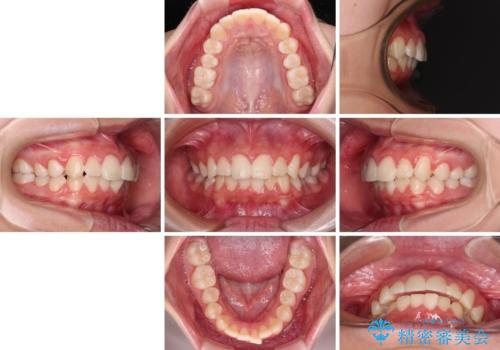 気がつくと唇があいてしまう ワイヤー装置での抜歯矯正の治療前