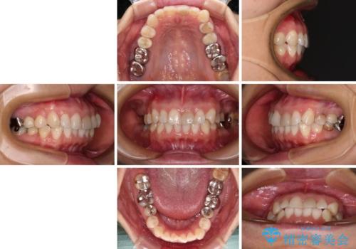 気になる下顎歯列のみをインビザラインで部分矯正の治療前