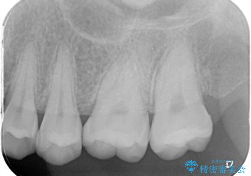 他院で虫歯と言われた　キレイでみがきやすい被せ物を入れたいの治療後