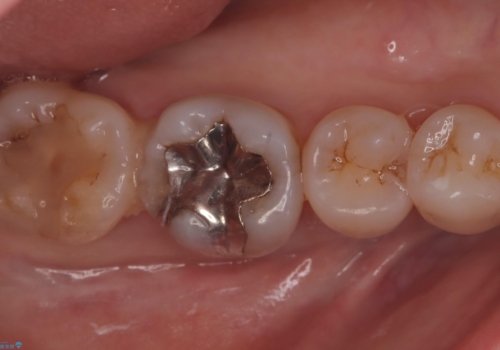 歯と歯の間に物がよく詰まる