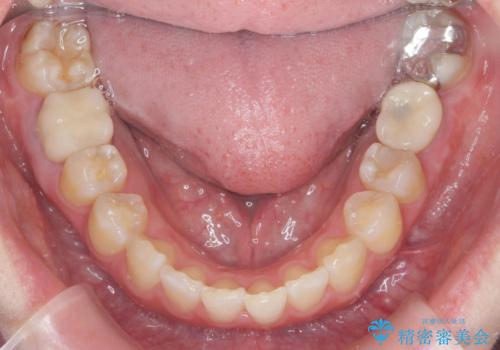 ねじれた前歯を改善するマウスピース矯正の治療後